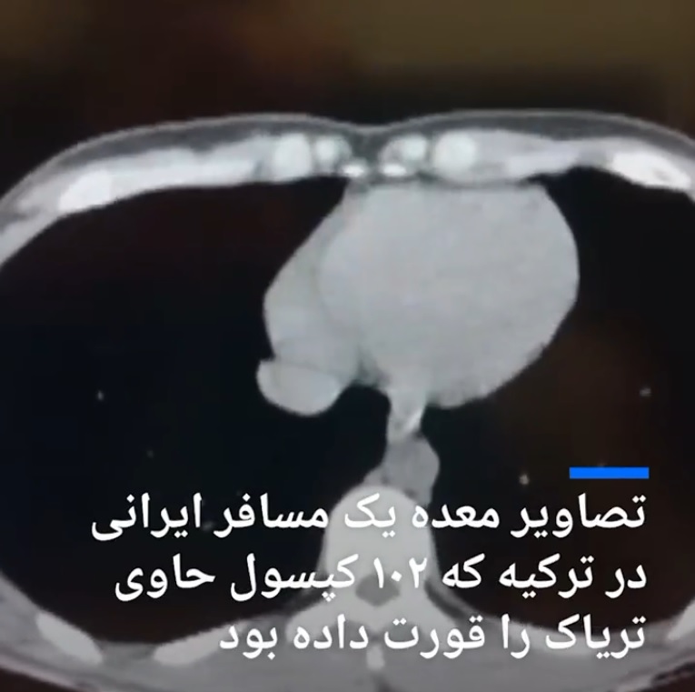 102 کپسول حاوی تریاک در معده یک ایرانی